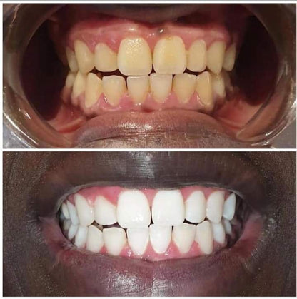 Dentifrice ultra blanchissant V34 : votre solution parfaite pour blanchir vos dents naturellement sans chirurgie et sans effet effet secondaire.