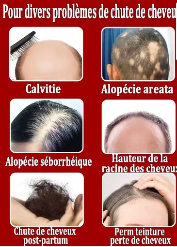 Huile capillaire Disaar : repousse rapide des cheveux et barbes, Chevelure Dense et Volumineuse – La Solution Naturelle à la Chute de Cheveux